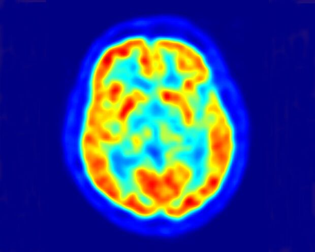 AL Gehirn im PET - Kontrastmittel leuchtet rot