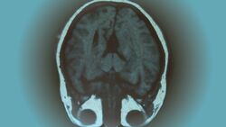 AL-illu-Gehirn-MRT-c-Monika-Torloxten_pixelio (jpg)