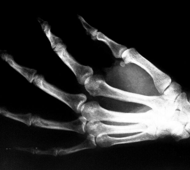 KL Röntgenbild einer Hand