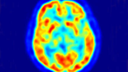 AL Gehirn im PET - Kontrastmittel leuchtet rot